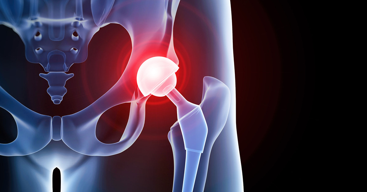 Signs You May Need a Hip Replacement